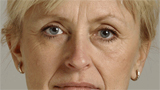 Dermal filler indications