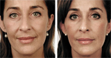 Dermal filler results